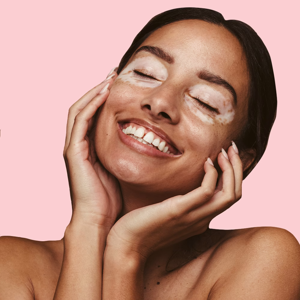 Smiling person with vitiligo on face.