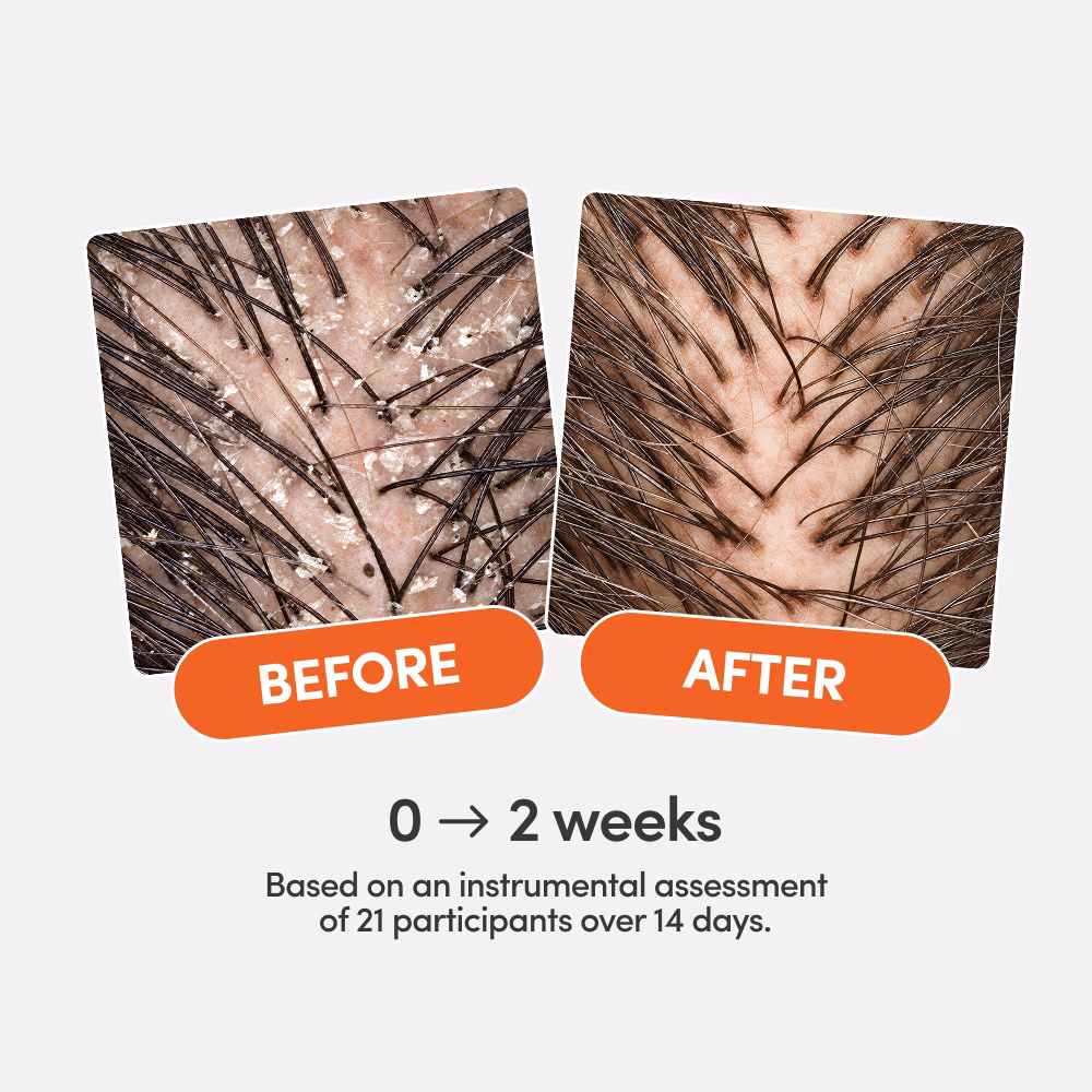 Scalp before and after treatment showing reduced flakes